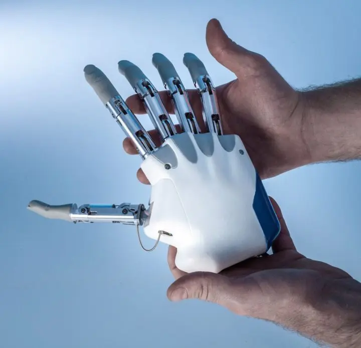ingegneria robotica-mano bionica-trapianto mano bionica-ospedale gemelli di roma